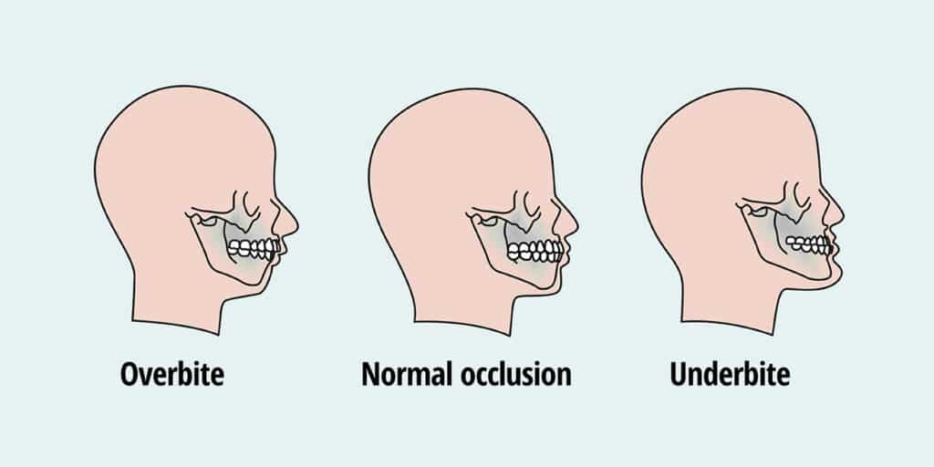 Image showing the difference between an overbite and underbite