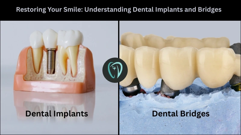 Understanding Dental Implants and Bridges